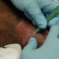 Expert-Recommended Techniques for Removing Slough From Wounds
